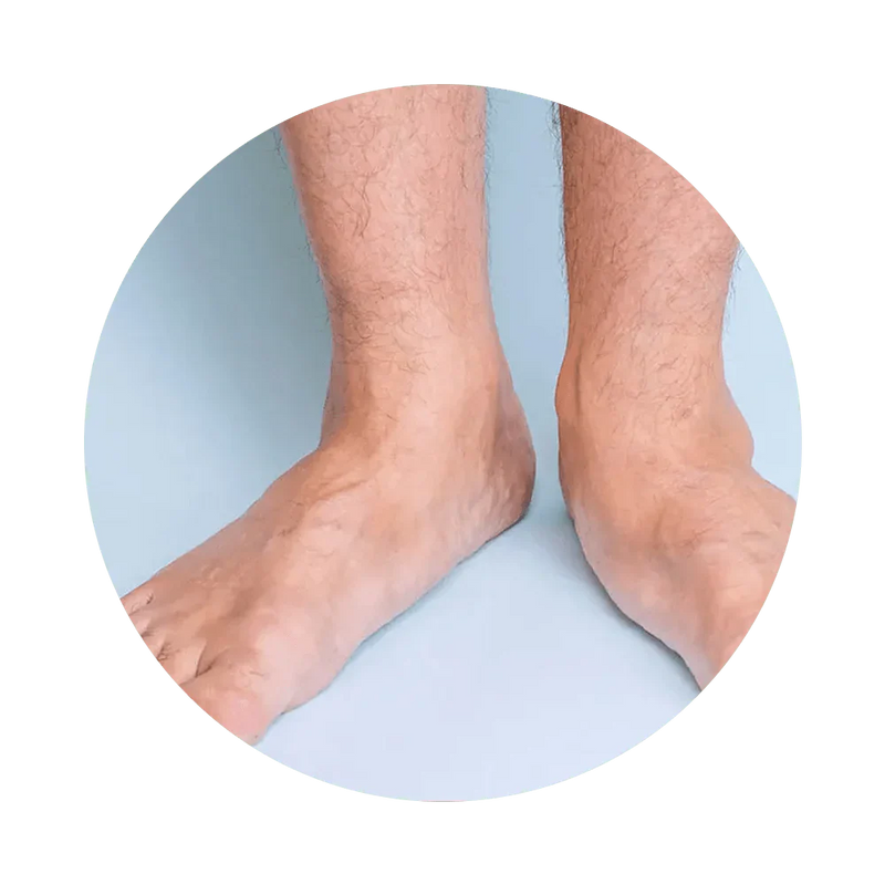 ALIVIO PARA LOS PIES PLANOS